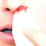 Is nose bleed dangerous?
