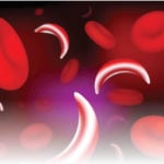 Sickle cell