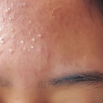 troublesome pimples