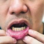 mouth wound