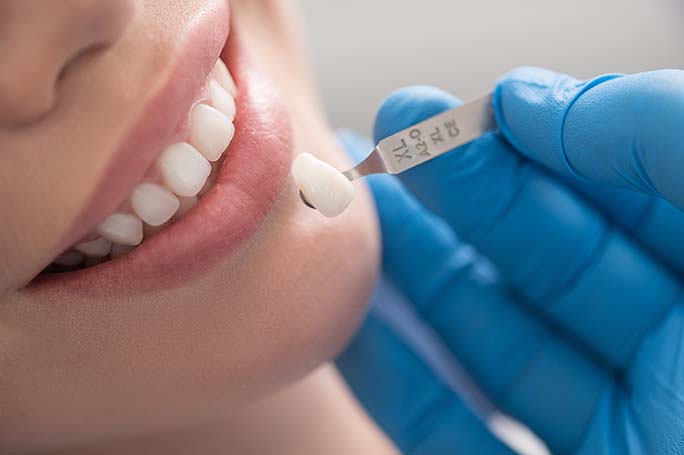 veneers