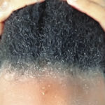 My daughter’s dandruff