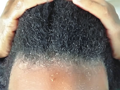 My daughter’s dandruff