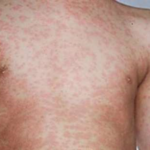 Dangerous in children My daughter’s measles, 107,500 people, mostly children, died due to measles in 2023