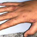 scabies