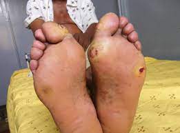 Rise in diabetic foot ulcers