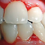 My bleeding gums