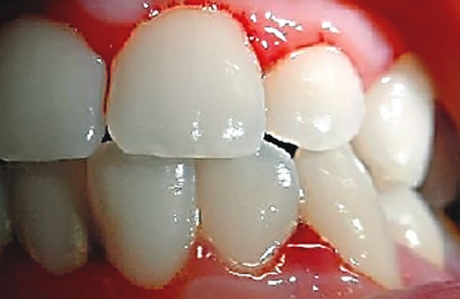 My bleeding gums