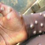 Causes of monkeypox, Monkeypox found in man having sex with man in Nigeria —Expert, Monkey pox Ogun records 4 new cases of monkeypox, Gombe Gombe declares outbreak of monkeypox, confirms 3 cases, Monkeypox, NCDC warns about surge in monkeypox cases in Nigeria, Bauchi records outbreak 