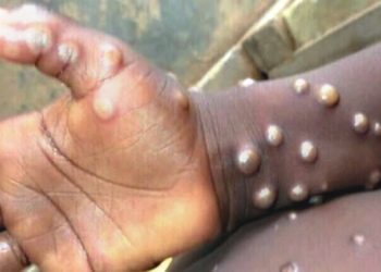 Causes of monkeypox, Monkeypox found in man having sex with man in Nigeria —Expert, Monkey pox Ogun records 4 new cases of monkeypox, Gombe Gombe declares outbreak of monkeypox, confirms 3 cases, Monkeypox, NCDC warns about surge in monkeypox cases in Nigeria, Bauchi records outbreak 