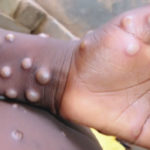 Two suspected monkeypox cases reported in Osun, How to prevent, syphilis could be monkeypox, 108 confirmed cases of Mpox recorded in Nigeria till date - Red Cross