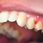 My bleeding gums