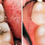 home remedies for tooth decay