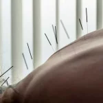 Acupuncture may help reduce urinary