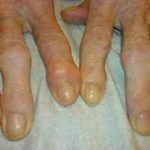Osteoarthritis damage ageing Expert,