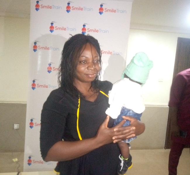 child born with lip cleft,