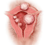 Natural ways to prevent fibroids, Fibroid
