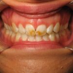 My problem with tooth decay