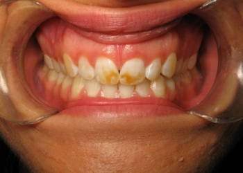 My problem with tooth decay