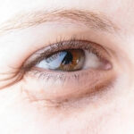 Does eye exercises work? Dark circles