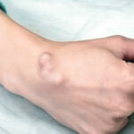 ganglion
