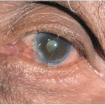 cataracts