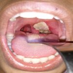Health agencies, Osun Diphtheria Ensure