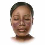 lupus