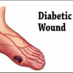 wounds