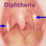 diphtheria