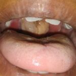 diphtheria outbreak