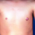 breast
