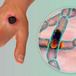 FG alerts Nigerians on confirmed anthrax anthrax? Anthrax