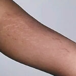 stretch marks