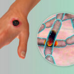 anthrax disease