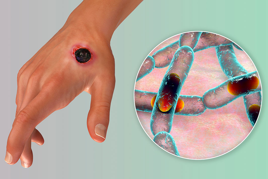 anthrax disease