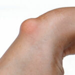 ganglion