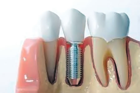 Dental implants