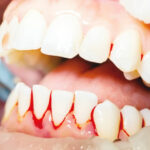 gum diseases, My bleeding gums