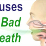 halitosis