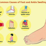 swollen feet