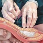 Caesarean delivery