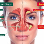 sinusitis