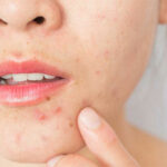 pimples