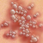 genital herpes