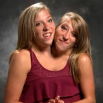 Conjoined twins