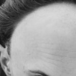 Receding hairline