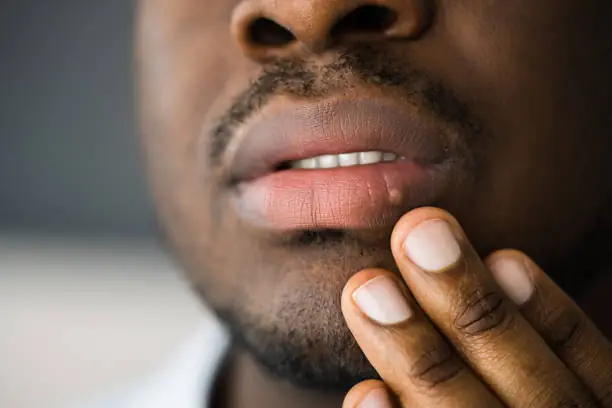 Top five facts, fictions about herpes simplex virus