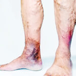 I have varicose veins