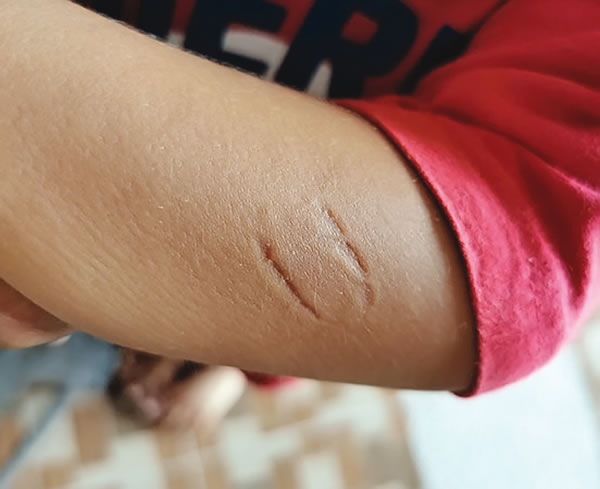 Are human bites dangerous